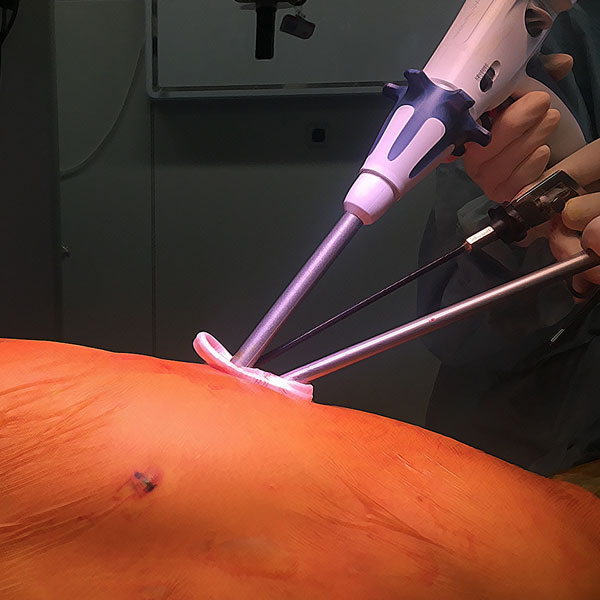 Chirurgie minimalement invasive : vidéo-thoracoscopie (VATS), chirurgie robotique vidéo-assistée (RATS), chirurgie par trocart unique
